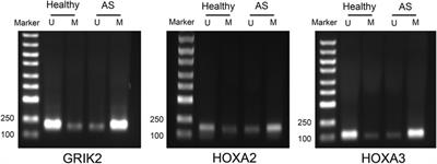 Bioinformatic analysis and experimental validation identified DNA methylation–Related biomarkers and immune-cell infiltration of atherosclerosis